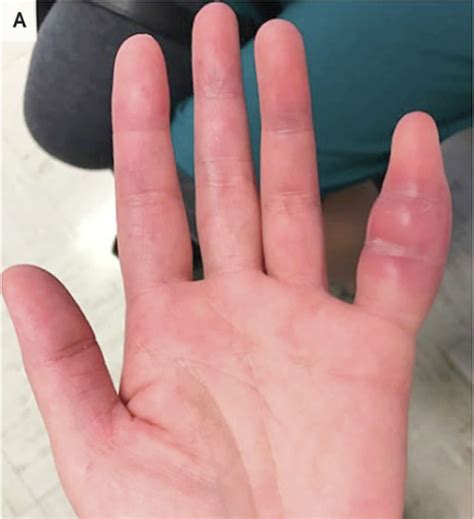 Woman's swollen pinky finger was rare sign of tuberculosis, UCSF