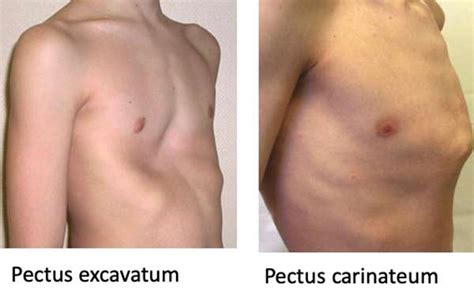 pectus excavatum carinatum  arcuatum points de difference