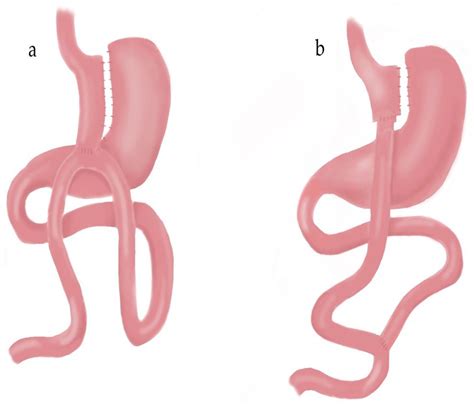 Medicina | Free Full-Text | One Anastomosis Gastric Bypass versus Roux