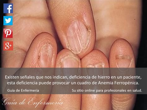 DEFICIENCIA DE HIERRO - GUÍA DE ENFERMERÍA