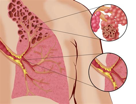 Popcorn Lung Images at Tashia Saenz blog