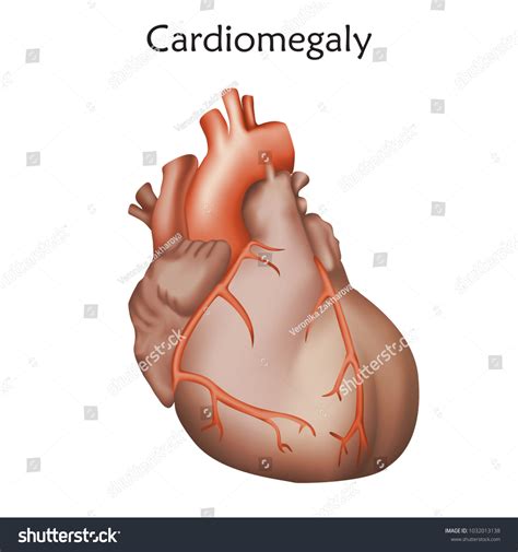 Cardiomegaly Diagram