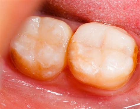 Dental reconstruction with resin: Dra. Claudia