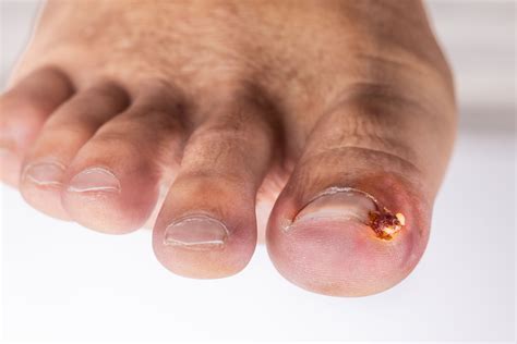 Ingrown Toenail Infection: Symptoms, Treatment, Causes