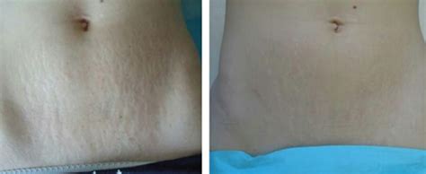 Subcisão Celulite Antes E Depois - Subcisão: O que é? Acaba com a celulite? Saiba tudo!
