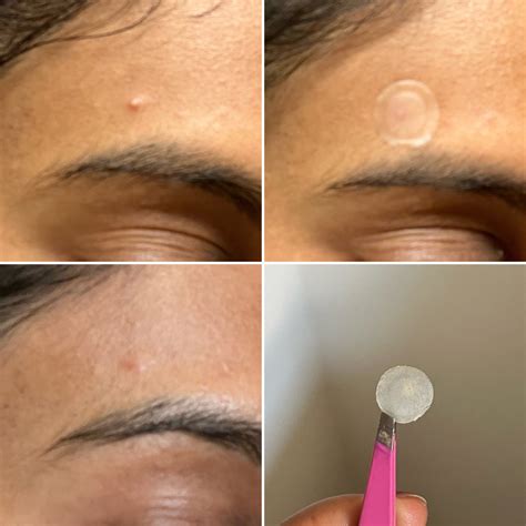 Good Molecules Pimple Patch Review With Photos | PS Beauty