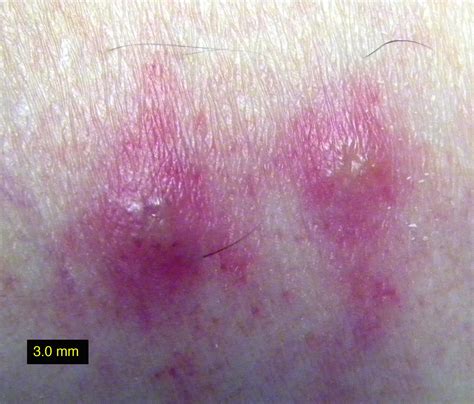 Chiggers - Dermatology - Medbullets Step 1