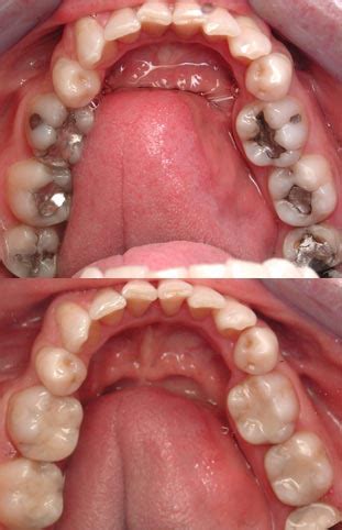 Tooth Colored Fillings - David Eshom, DDS, San Diego