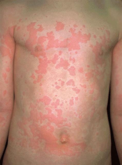 Anafilaxia: o que é, fisiopatologia, sintomas e tratamento