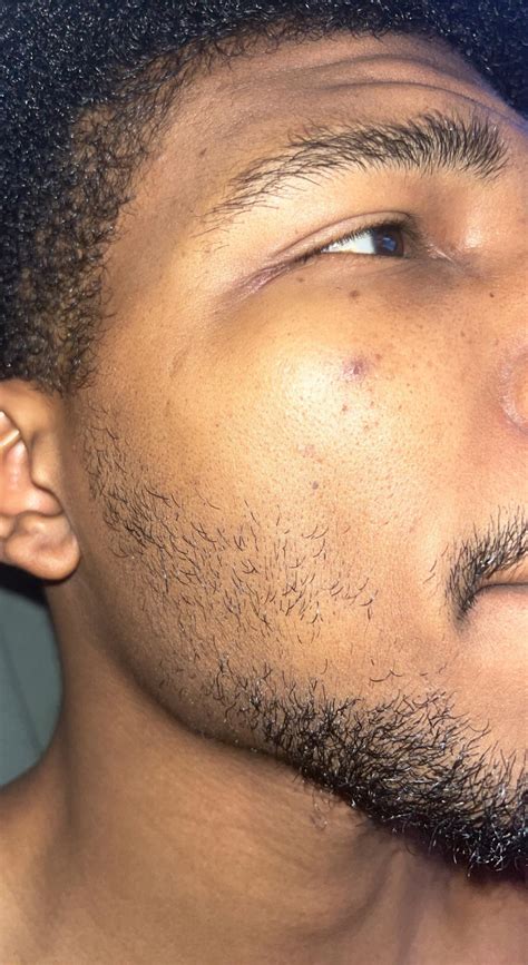Warning: This Unbelievable Blackhead Removal 2024 Method Is Addictive! Image 1