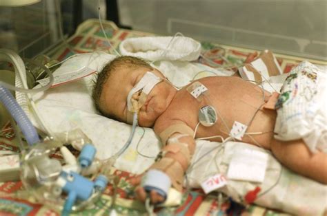 Premature birth | Definition, Causes, & Health Effects | Britannica