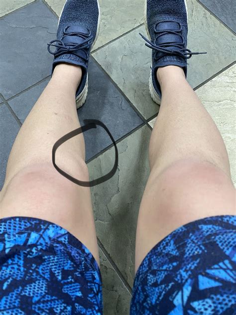 I have an extra bone growth next to my knee that I like to call my