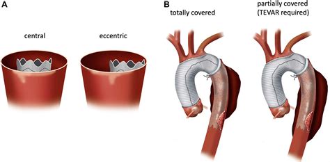 early intraluminal frozen elephant trunk stent graft thrombosis