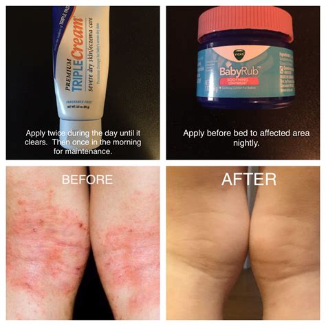 Apple Cider Vinegar Bath For Molluscum Contagiosum at Guadalupe Harshaw