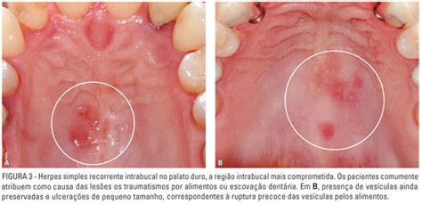 Herpes Ceu Da Boca - Herpes Simples Na Boca