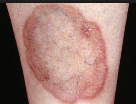 cutaneous manifestations flashcards quizlet