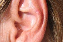 Ear Shingles Symptoms | Healthfully