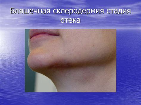 Коллагенозы: красная волчанка, склеродермия - презентация онлайн