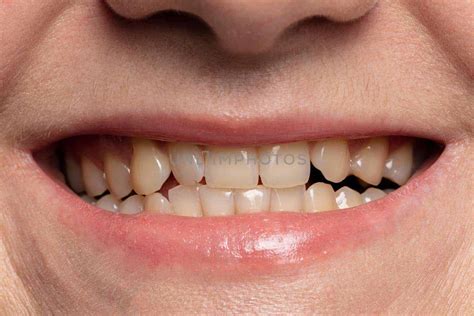 Baking Soda Teeth Whitening Hack | Excellent Facts About It!