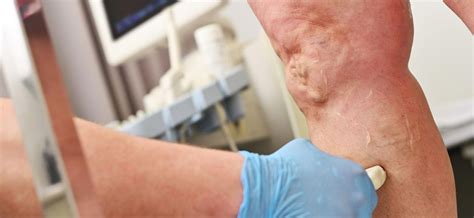 Arterial Disease Archives - Sonoran Vein and Endovascular
