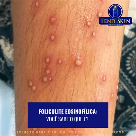 O Que Significa Foliculite - Foliculite Eosinofílica: Você Sabe O Que é?