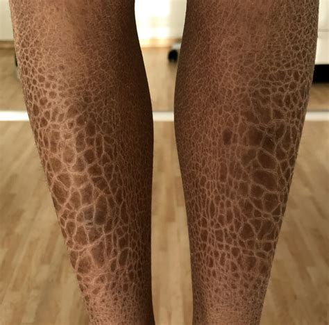medical student lives   linked congenital ichthyosis scary symptoms