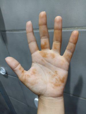 Palma Das Mãos E Sola Dos Pés Amarelos - Manchas amarelas na palma da mao/sola do pé - Page 5 | BabyCenter