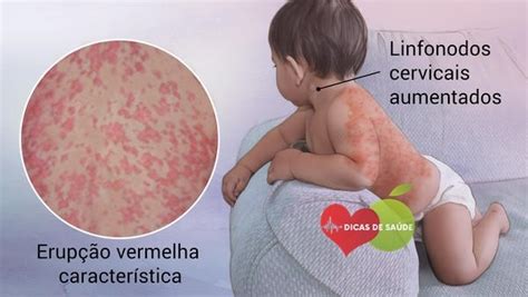 Sintomas De Rubéola Em Criança