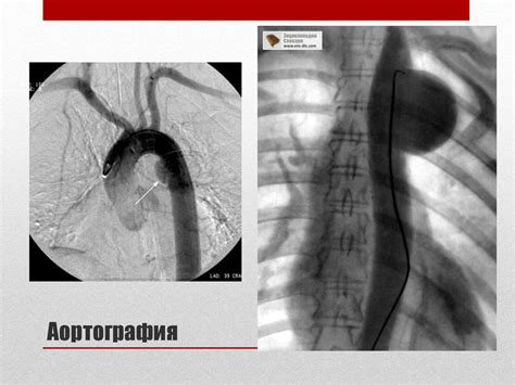 Аневризма грудной аорты - презентация онлайн