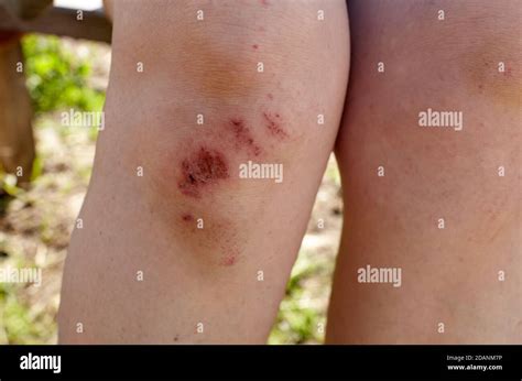 Scraped knee hi-res stock photography and images - Alamy
