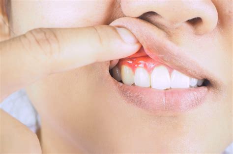 Dental Cyst vs Abscess: 5 Signs You Need a Dentist - Digital Trends Report