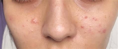 Raised Skin Bumps: Pictures, Types, Causes, And Treatment, 46% OFF