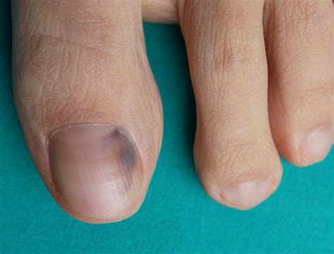 Difference Between Toenail Hematoma and Melanoma | Difference Between