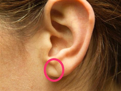 Earlobe Crease: How It Relates to Coronary Artery Disease