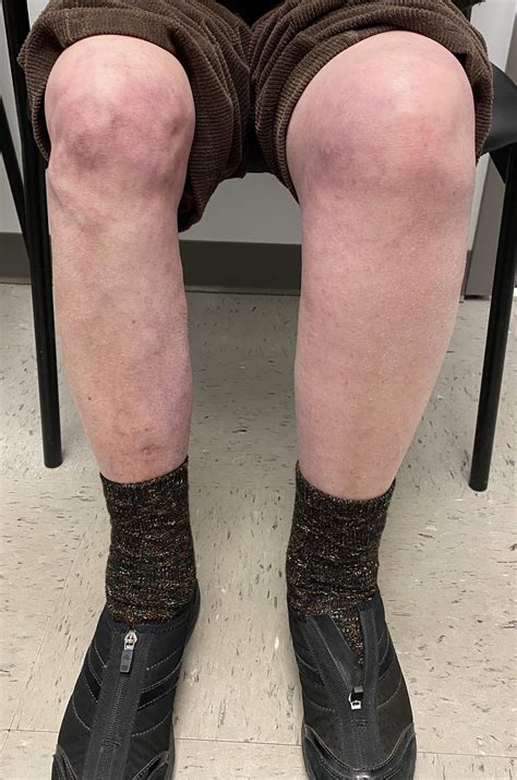 Deep Vein Thrombosis (DVT) - Access Care Vascular - Buffalo, NY