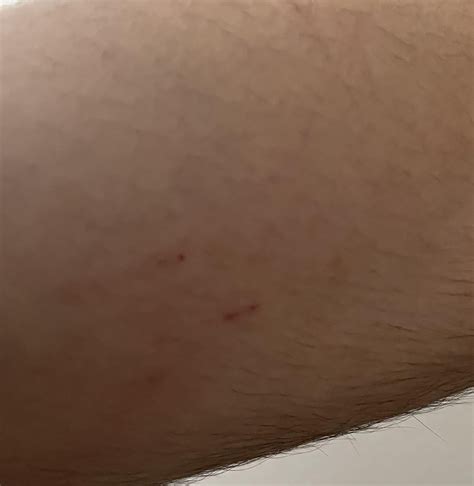 Scared of rabies, possible bat or rat bite : r/rabies