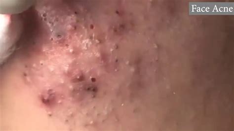 acne blackhead cyst popping youtube