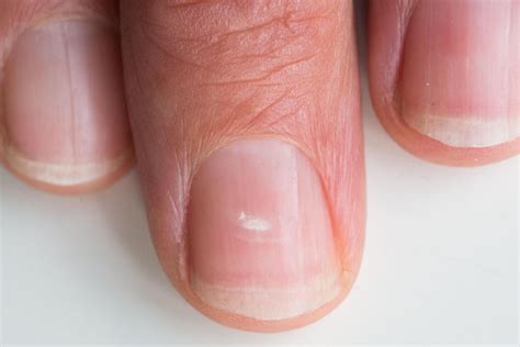 white spots   fingernails meaning  marc rogers blog