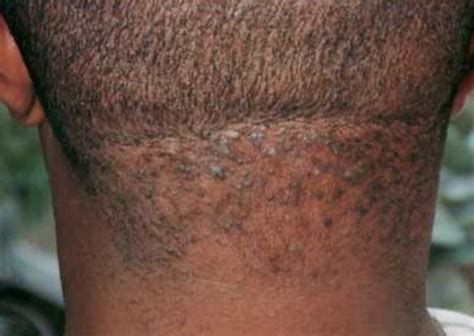 razor bumps symptoms