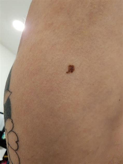 early stages of nodular melanoma? : r/Melanoma