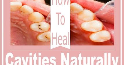 How To Heal Cavities Naturally