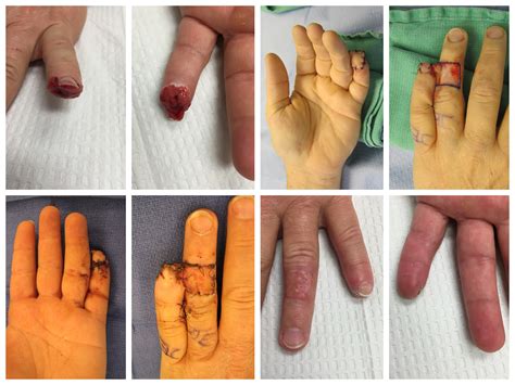 Cross Finger Flap Reconstruction - John Erickson, MD