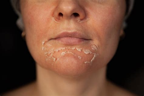 ¿Por qué te deberías plantear hacerte un peeling químico facial ...