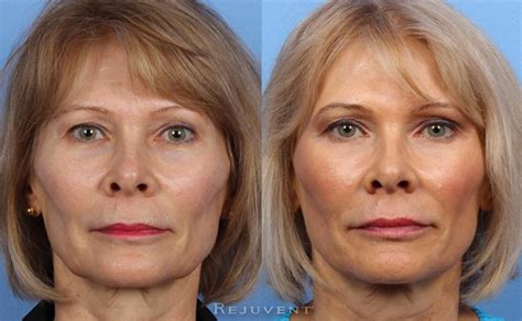 Liquid Facelift Photos Beautiful Results Rejuvent Scottsdale