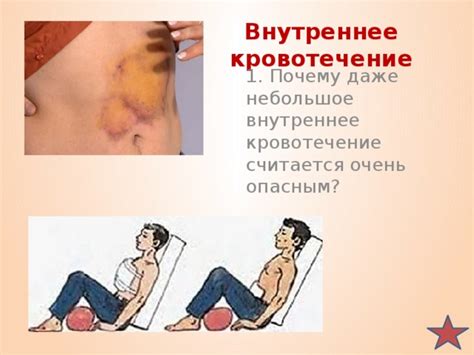 Первая помощь при кровотечениях - биология, презентации