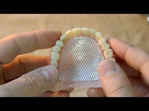 Укрепление зубного протеза-армирование - YouTube | Brackets dentales ...