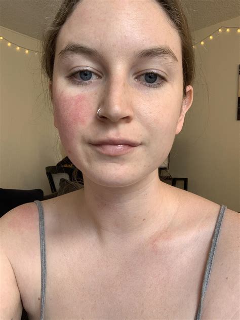 Why Do Some People Have Rosy, Red, or Bright Chin Cheeks? 1