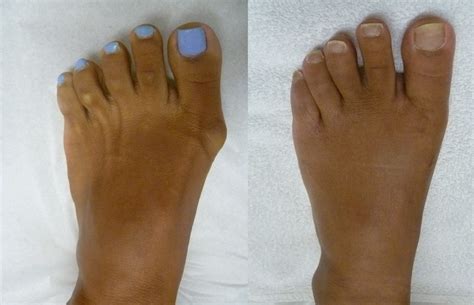 Before and After Surgeries | Artisan Foot and Ankle Specialists
