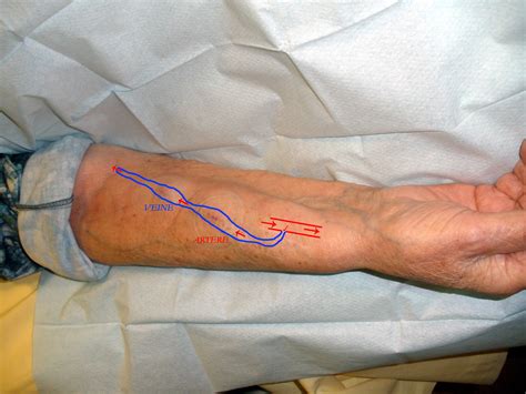 What Is Av Fistula Surgery at Adela Coletti blog