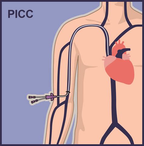 PICC Lines | Vascular Wellness